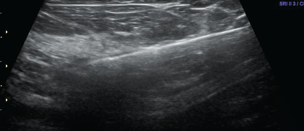 Biopsia guiada por ultrasonido
